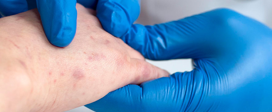 Epidemie de Rujeolă în România: Ministerul Sănătății lansează măsuri urgente